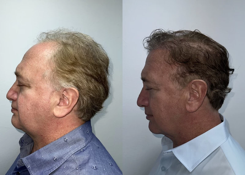 Patient p686 hair transplant before and after left view