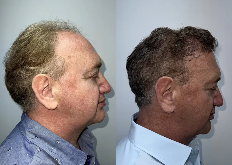 Patient p686 hair transplant before and after right view