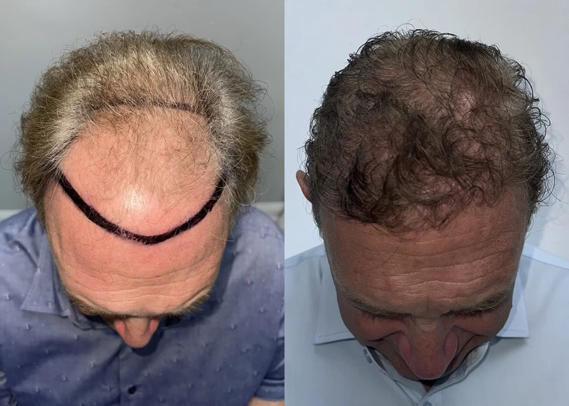 Patient p686 hair transplant before and after tilt view