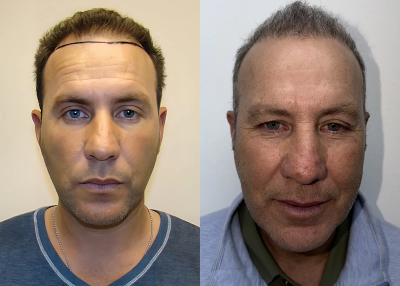 Jose Hair Transplant Before and After