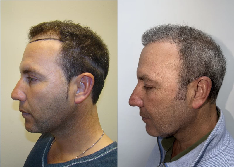 Patient p687 hair transplant before and after left view