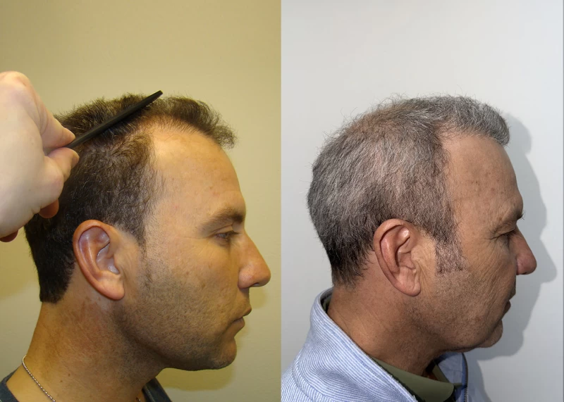 Patient p687 hair transplant before and after right view