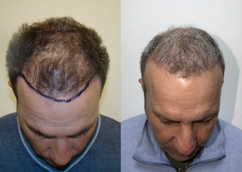 Patient p687 hair transplant before and after tilt view