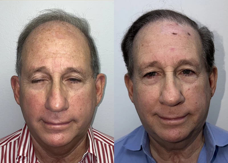 Bruce  Hair Transplant Before and After