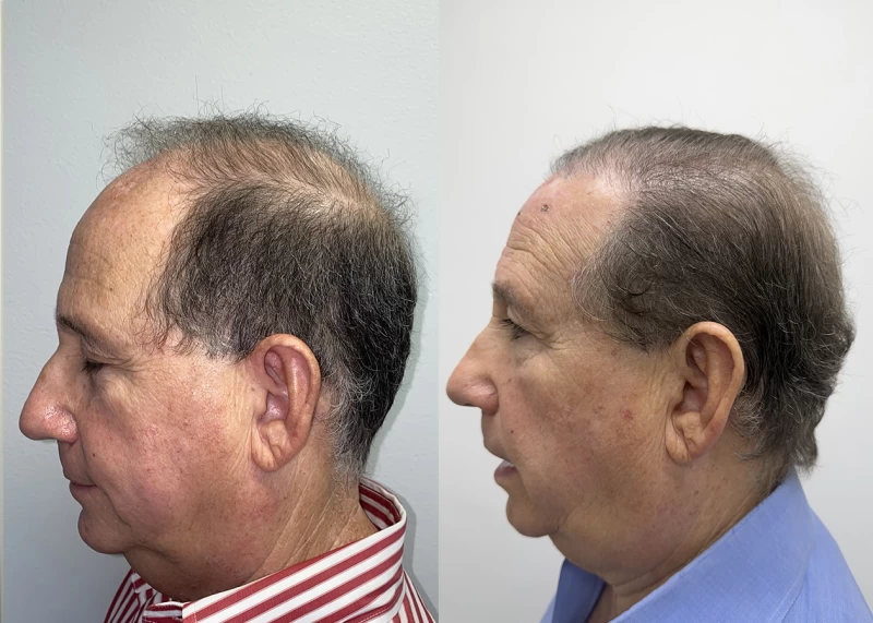 Patient p688 hair transplant before and after left view
