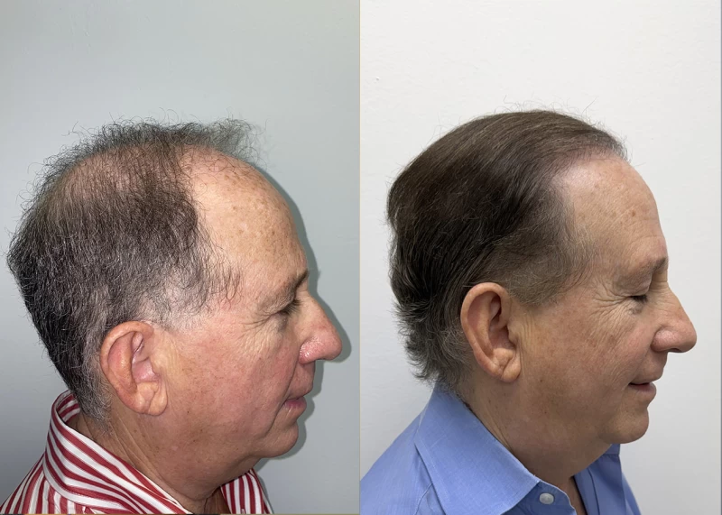 Patient p688 hair transplant before and after right view