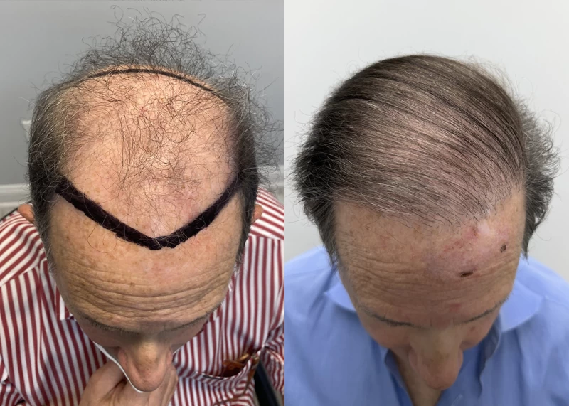Patient p688 hair transplant before and after tilt view