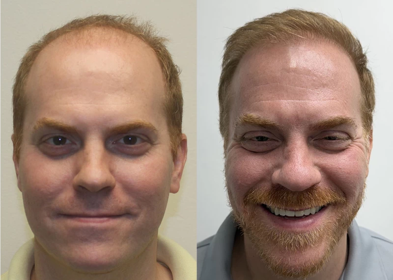 Tyler Hair Transplant Before and After
