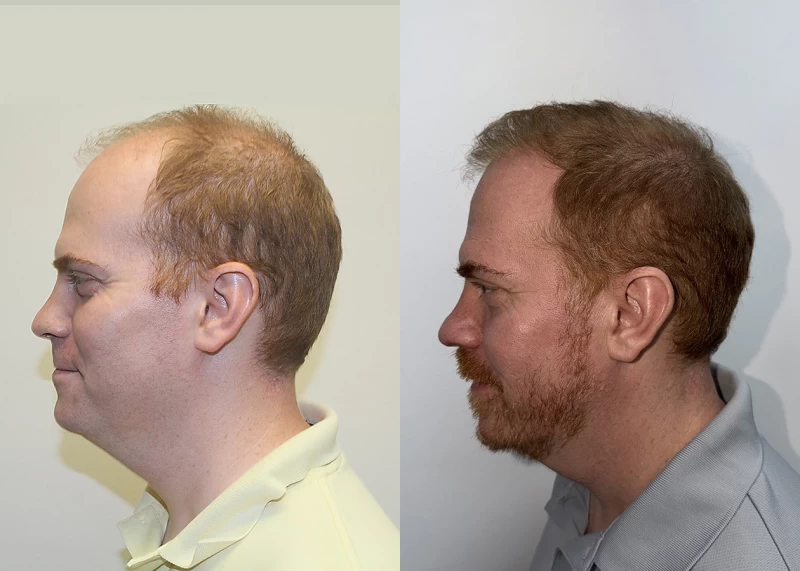 Patient p689 hair transplant before and after left view