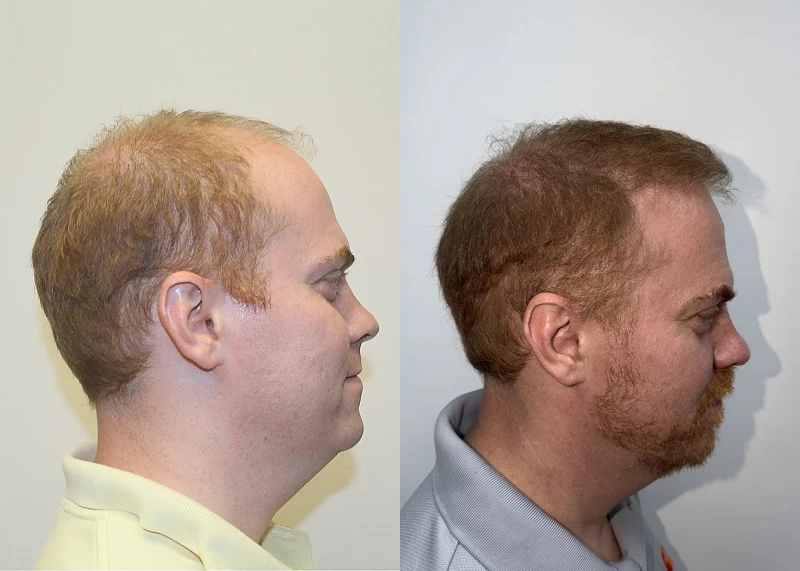 Patient p689 hair transplant before and after right view