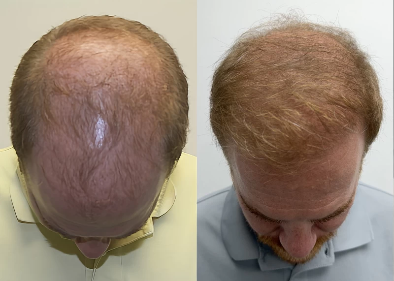 Patient p689 hair transplant before and after tilt view