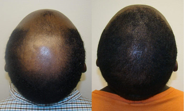 Patient p68 hair transplant before and after crown view