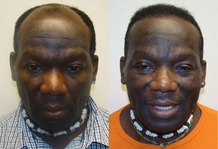 Angel Hair Transplant Before and After