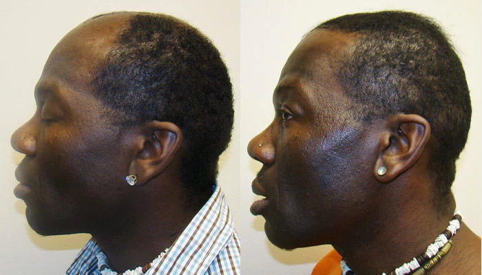 Patient p68 hair transplant before and after left view