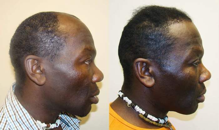 Patient p68 hair transplant before and after right view