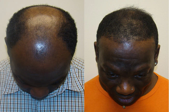Patient p68 hair transplant before and after tilt view