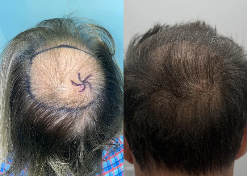 Patient p690 hair transplant before and after crown view