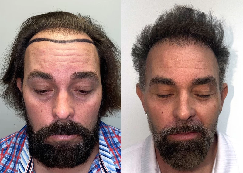 Willam Hair Transplant Before and After