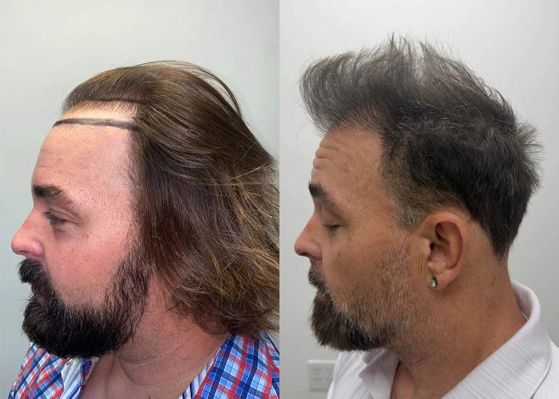 Patient p690 hair transplant before and after left view