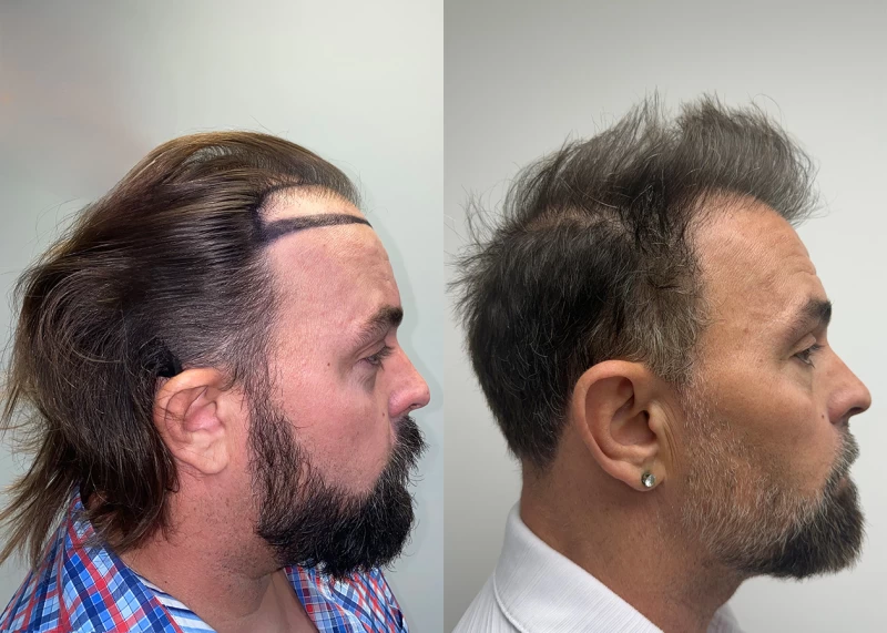Patient p690 hair transplant before and after right view