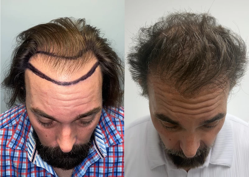 Patient p690 hair transplant before and after tilt view