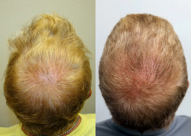 Patient p691 hair transplant before and after crown view