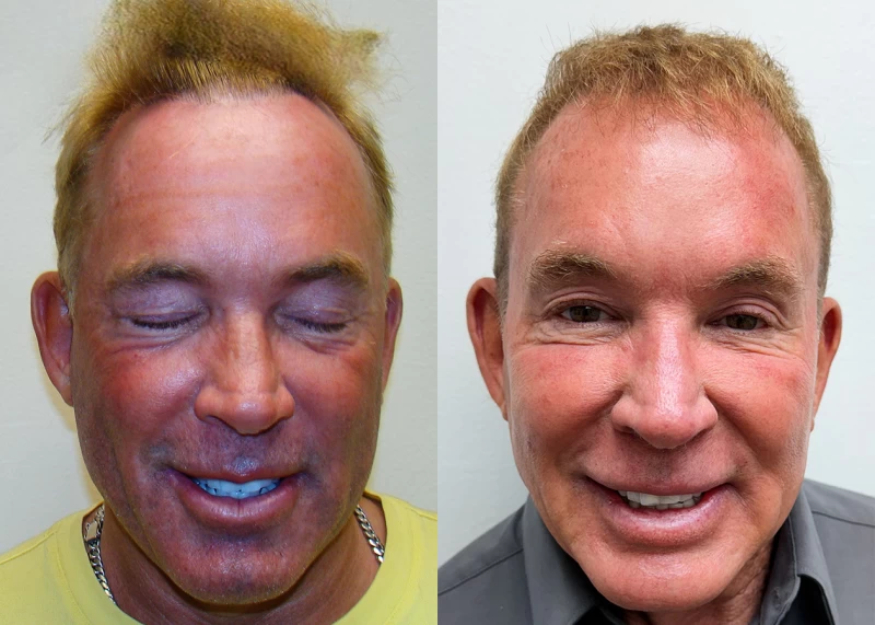 Kevin  Hair Transplant Before and After