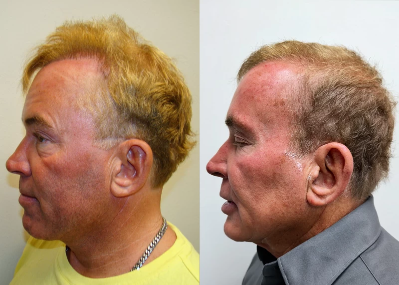 Patient p691 hair transplant before and after left view