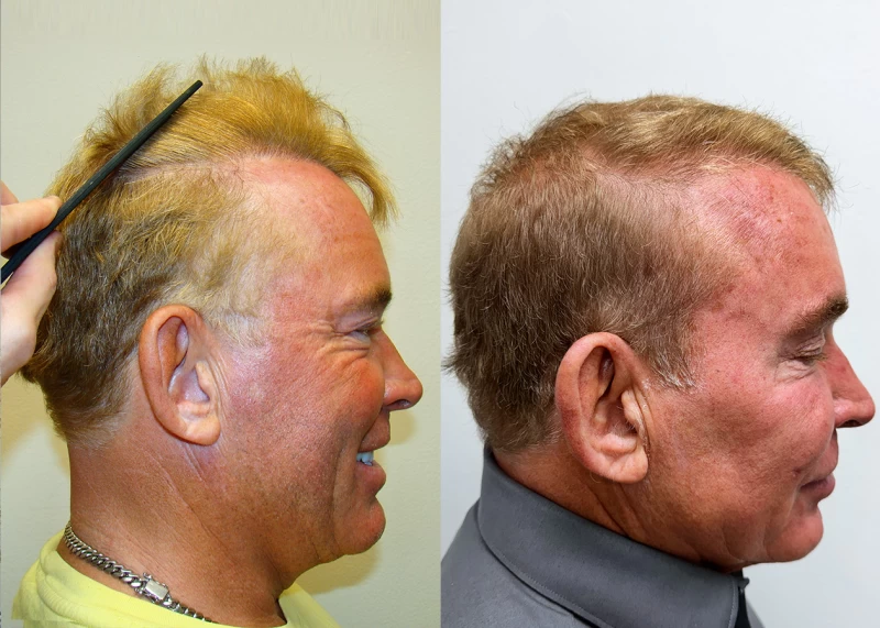 Patient p691 hair transplant before and after right view