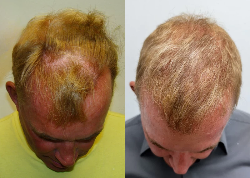 Patient p691 hair transplant before and after tilt view