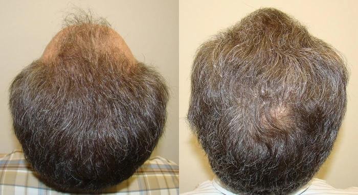 Patient p69 hair transplant before and after crown view