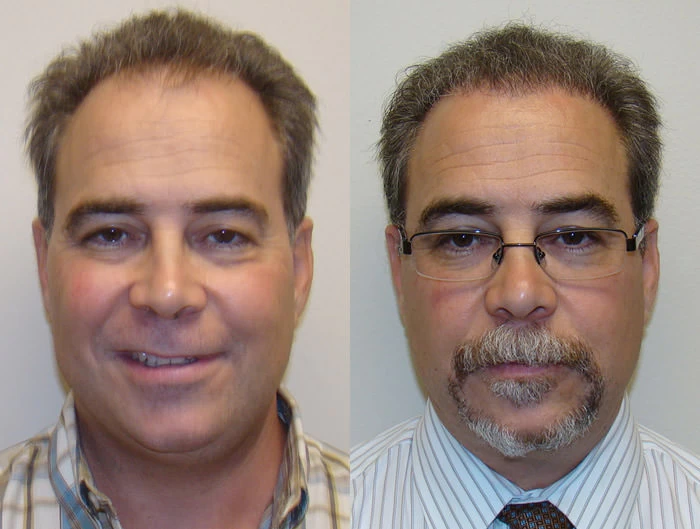 Charles Hair Transplant Before and After