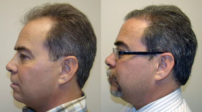 Patient p69 hair transplant before and after left view