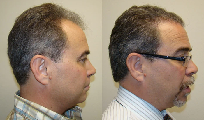 Patient p69 hair transplant before and after right view