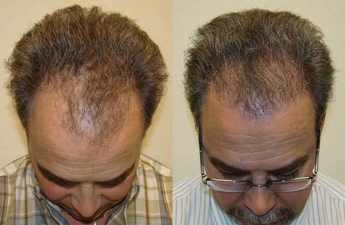 Patient p69 hair transplant before and after tilt view