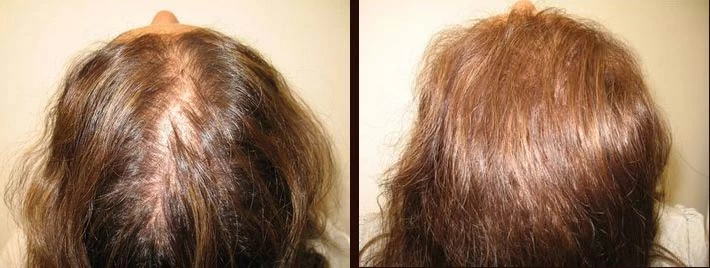 Patient p6 hair transplant before and after crown view