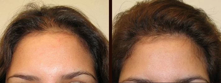 Patient 6 Hair Transplant Before and After