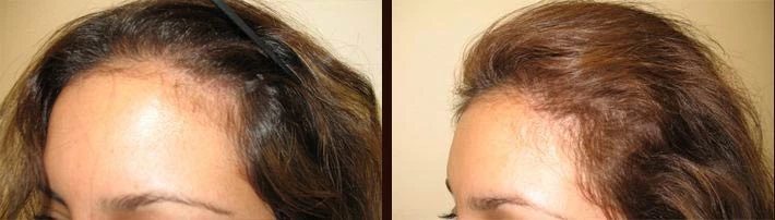 Patient p6 hair transplant before and after left view