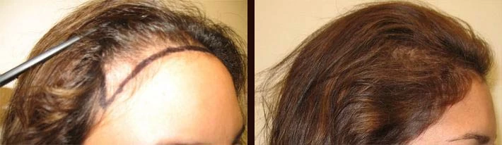 Patient p6 hair transplant before and after right view