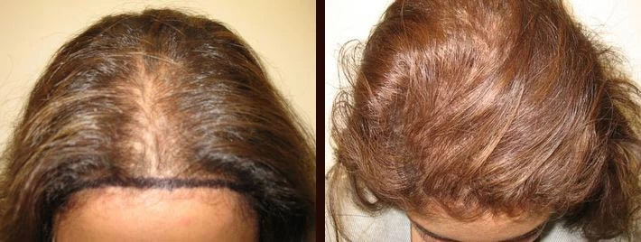 Patient p6 hair transplant before and after tilt view