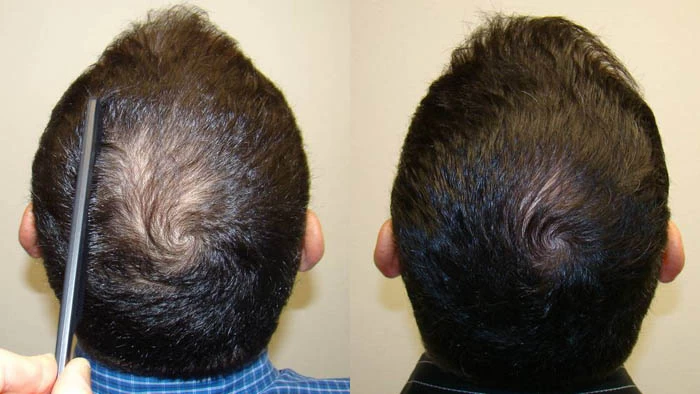 Patient p70 hair transplant before and after crown view