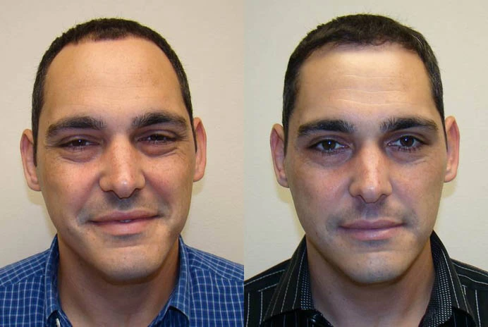 Brian Hair Transplant Before and After