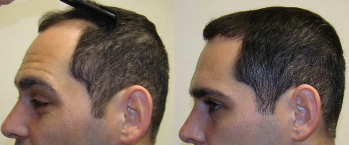 Patient p70 hair transplant before and after left view