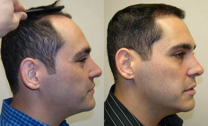 Patient p70 hair transplant before and after right view