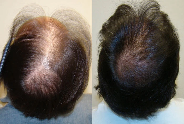 Patient p73 hair transplant before and after crown view