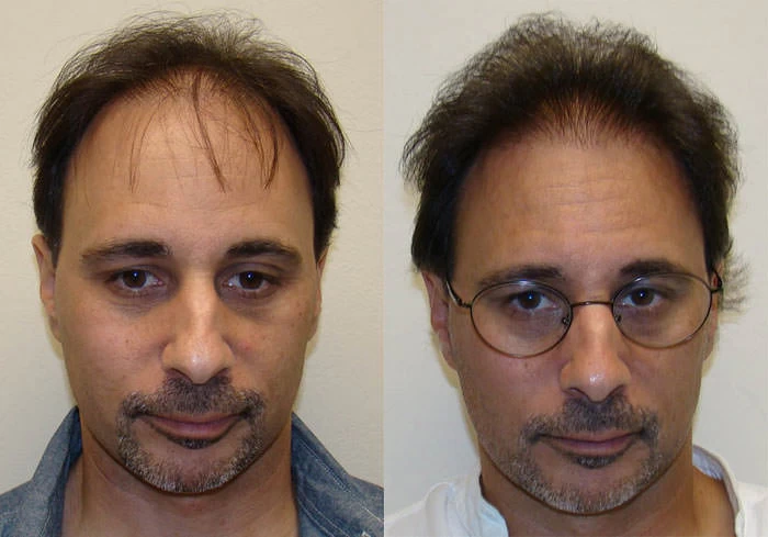Dominic Hair Transplant Before and After