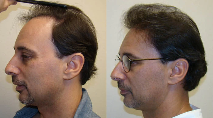 Patient p73 hair transplant before and after left view
