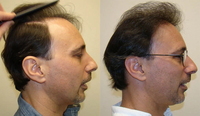 Patient p73 hair transplant before and after right view