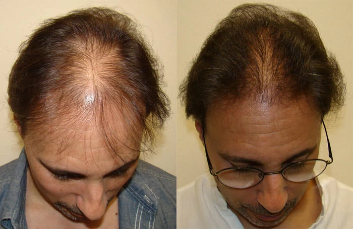 Patient p73 hair transplant before and after tilt view