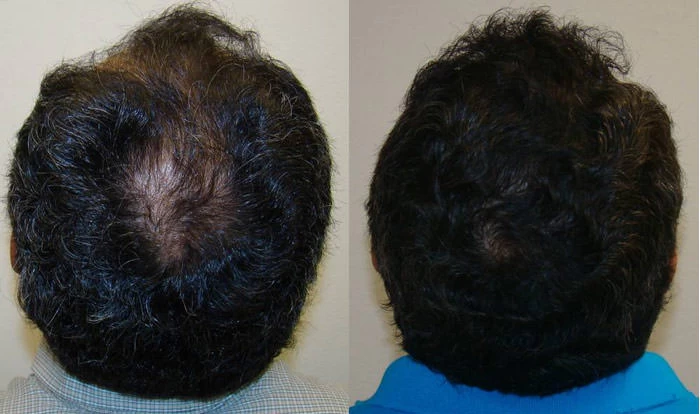 Patient p74 hair transplant before and after crown view